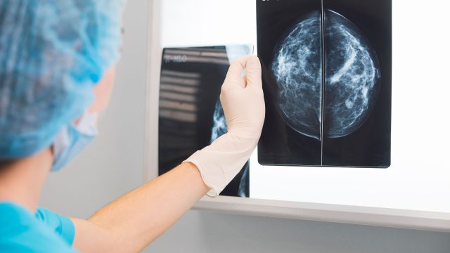 Estrogen a more powerful breast cancer culprit than we realized